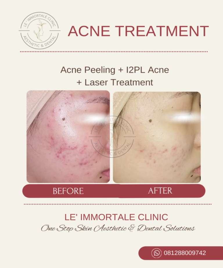 Acne Treatment 2