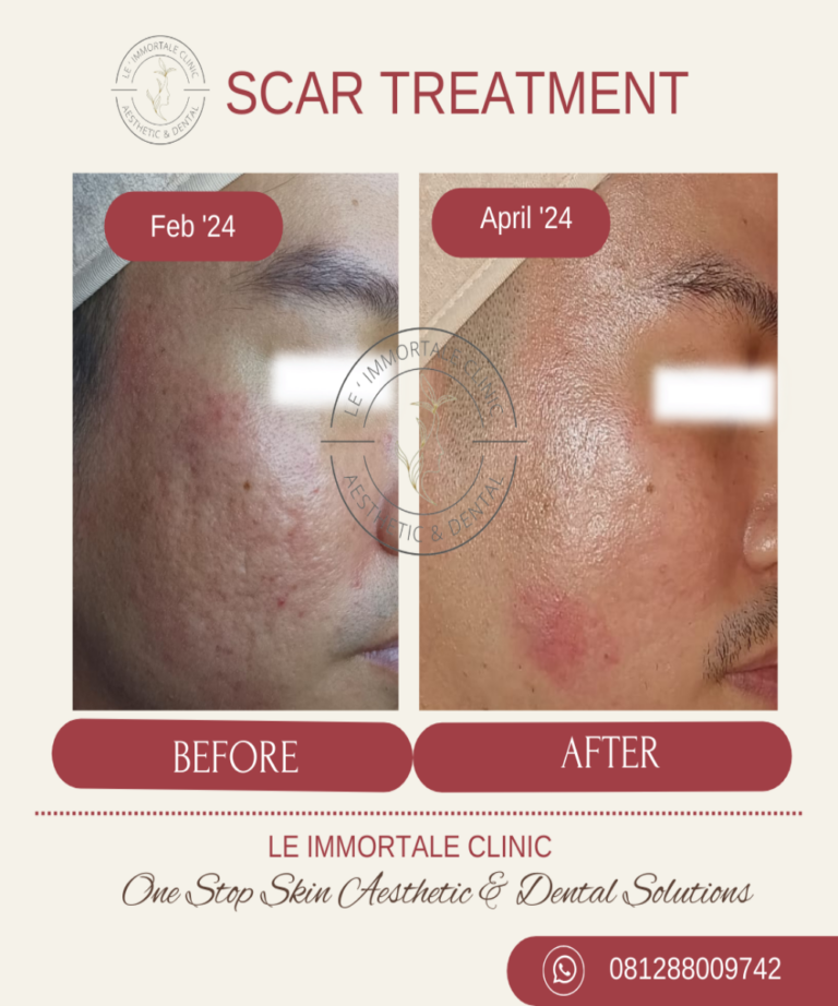 Scar treatment