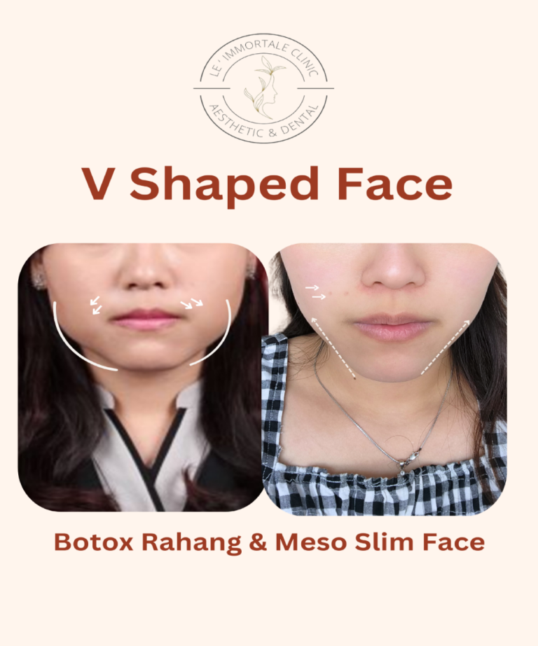 V shaped treatment