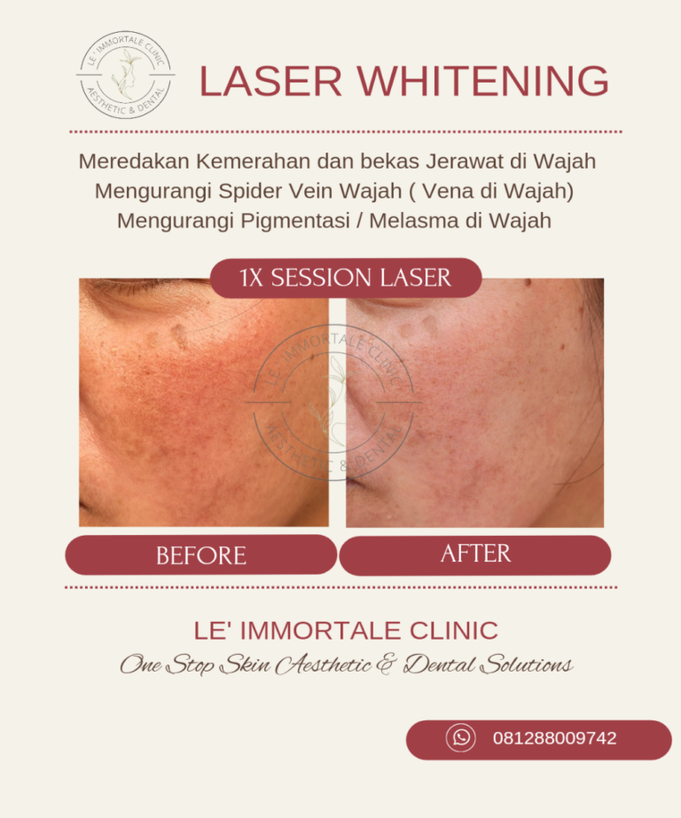 Whitening laser 2