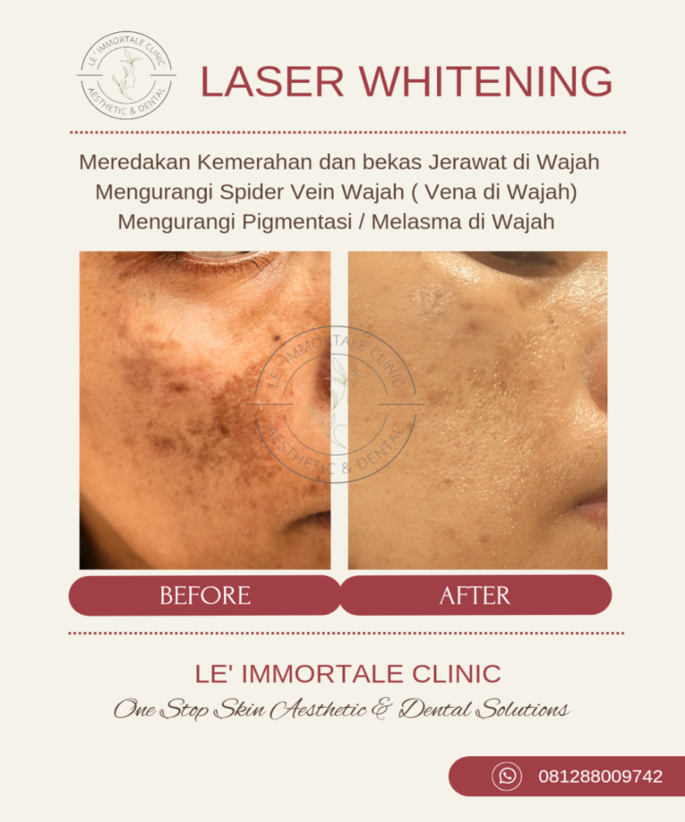 Whitening laser