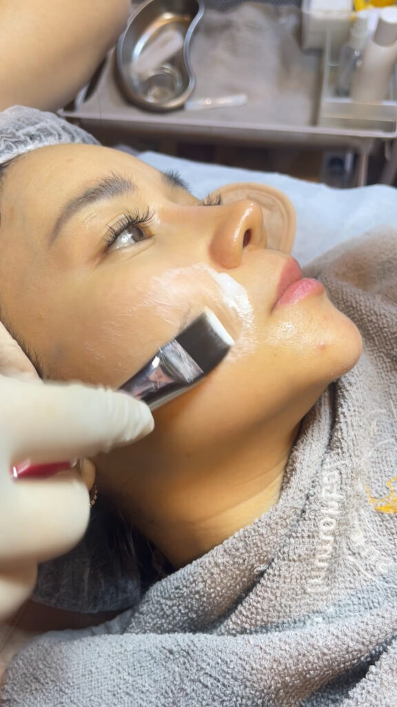 Treatment LHALA Peel di Le' Immortale Clinic
