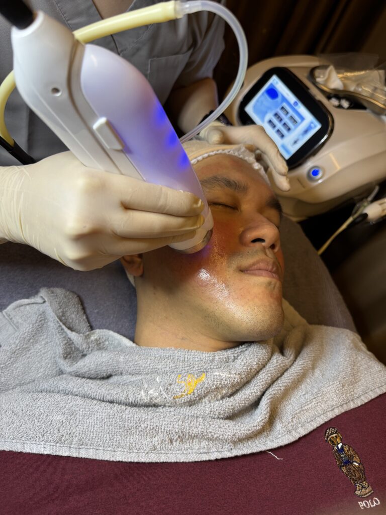Treatment RF Microneedling pada wajah di Le' Immortale Clinic