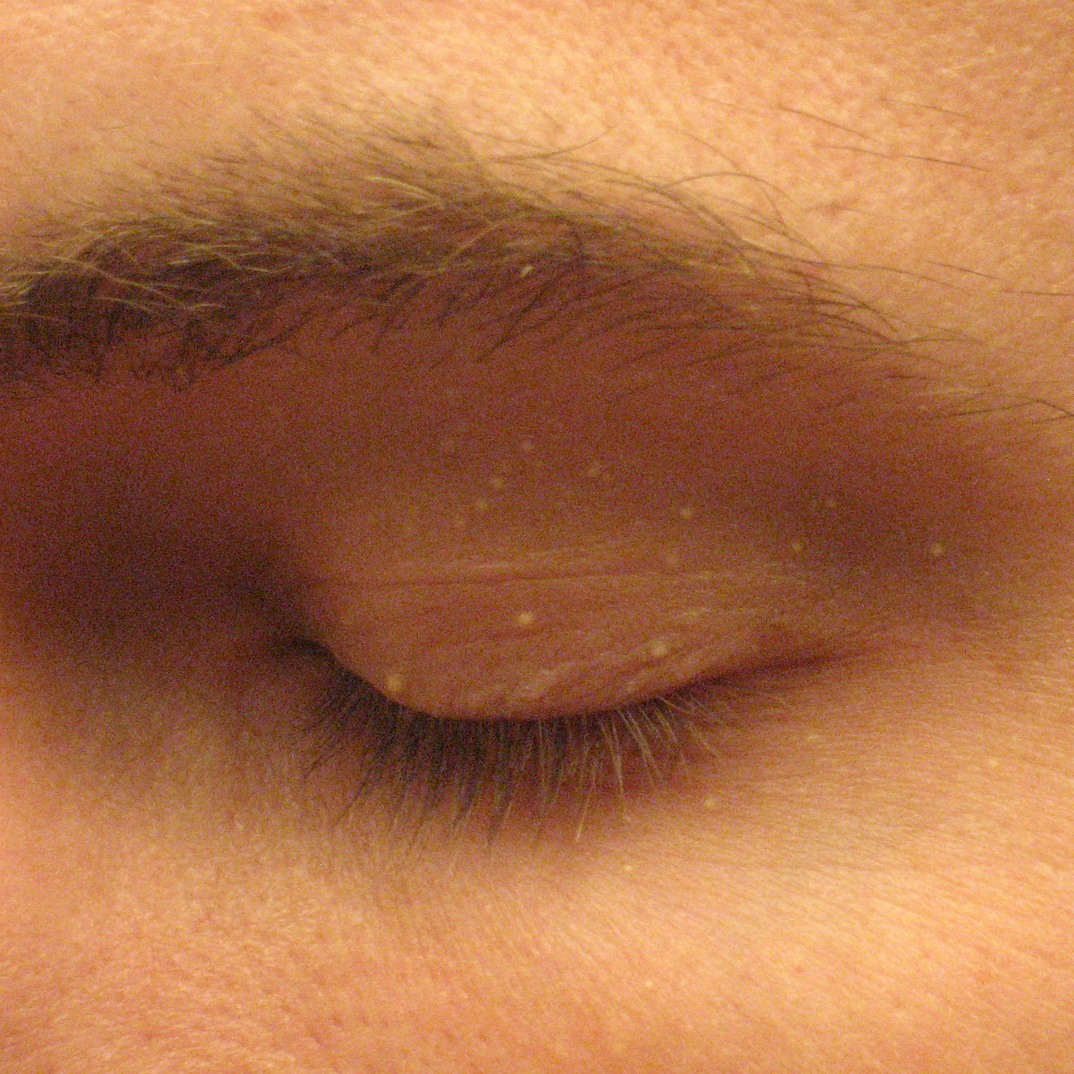 Close-up milia pada kelopak mata sebelum treatment Cauterization
