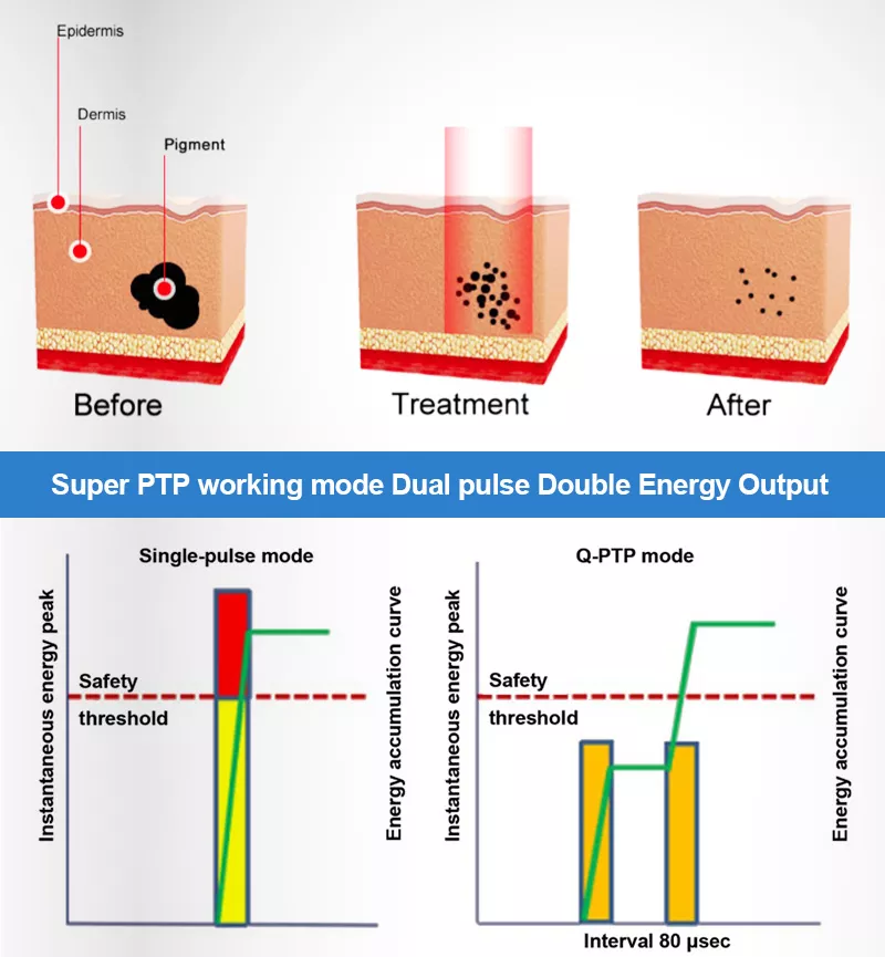 Diagram cara kerja teknologi Q-PTP dual pulse dalam menghancurkan pigmen kulit secara lebih terkontrol
